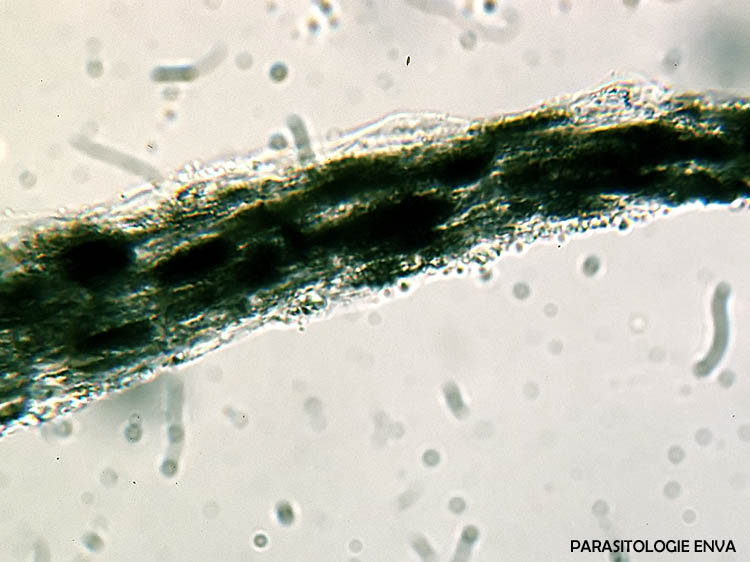 dysplasie folliculaire