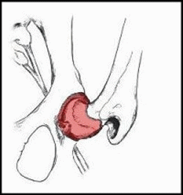 voir 3 : si le volume synovial est augment...