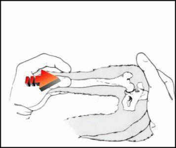 Subluxation de la hanche
