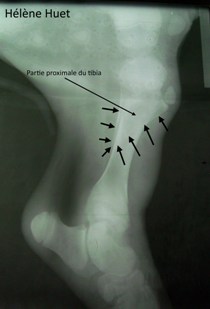 fracturetibiaveau