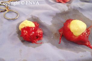 abcs de noeuds lymphatiques