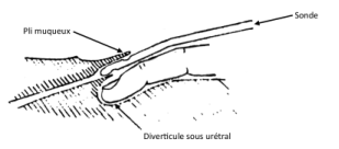 catheterismeuretral