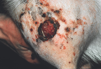 Carcinome cellulaire squameux de la chèvre JM.G. 01