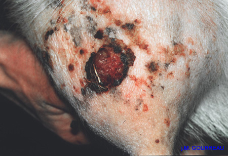 Carcinome cellulaire squameux de la chèvre JM.G. 01
