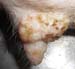 nodules_trayon_ov4