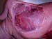 suspicion_avort_chlam_ov_ginie (6)