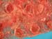 fievre_q_placenta_piadc_cp2