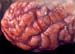listeriose_meningoencephalite_ov_ceva