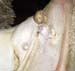 anomalie cicatrisation post gangreneuse (2)