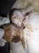 anomalie cicatrisation post gangreneuse (8)