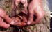 ov_prolapsus_apres_amputation_lesions_vulvovaginales