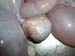 massecol_tumeurovaire_pseudogest_hyperplasieglandulokystique_ov (14)