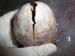 massecol_tumeurovaire_pseudogest_hyperplasieglandulokystique_ov (18)