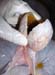 massecol_tumeurovaire_pseudogest_hyperplasieglandulokystique_ov (19)
