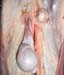 testicule_inguinal_peau_retiree_ov