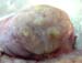 epididyme_suppure_ov