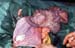 herniescrotale_hernieouverte_ov_pathorepro