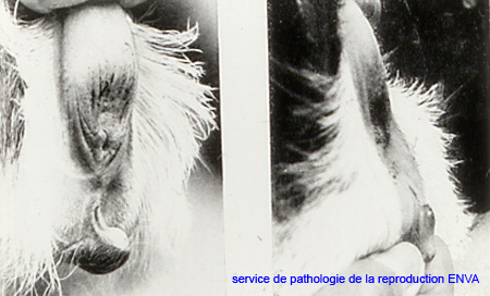 cp_pseudohermaphrodisme_clitoris_peniforme