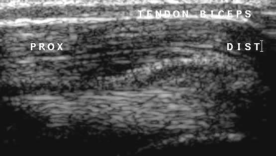 TD BICEPS CL