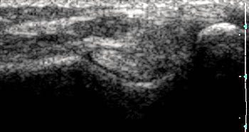 tENDON BICEPS CT